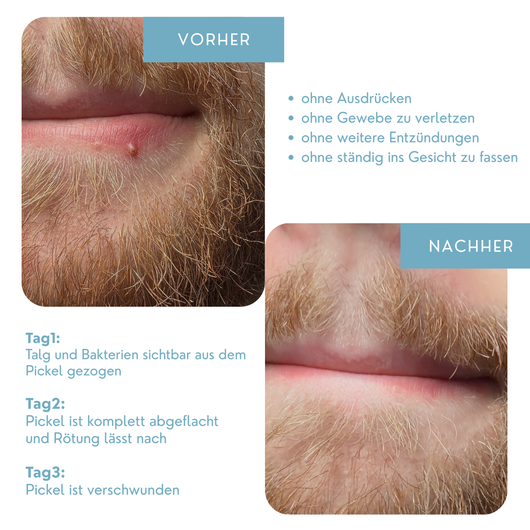 Azaléa Anti-Pickel Patch Rolle™