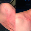 Sandra M., Post-OP Schulter